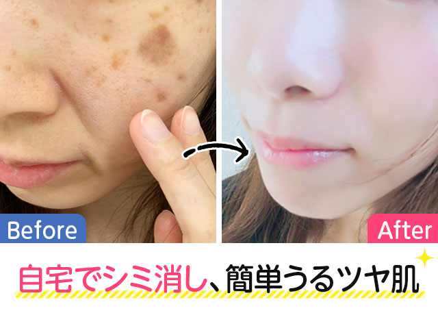 自宅でシミは消せる!